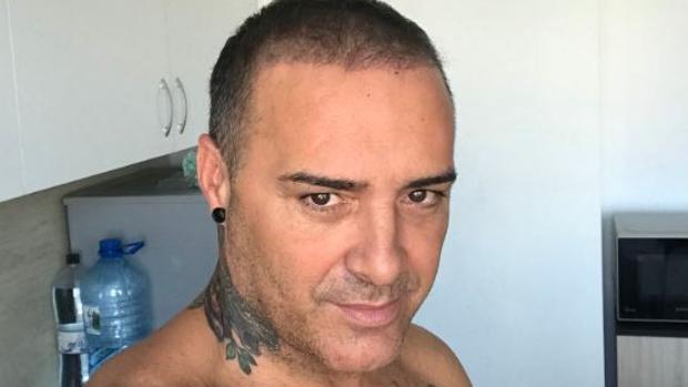 La pesadilla de Dinio tras su injerto capilar