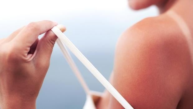 ¿Qué hacer cuando te quemas con el sol?