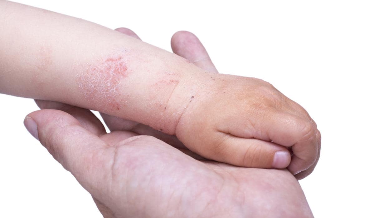 La dermatitis atópica se manifiesta antes de los 6 primeros meses de vida