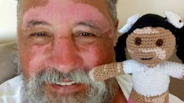 El emotivo detalle de un abuelo: crea una muñeca con vitíligo para su nieta