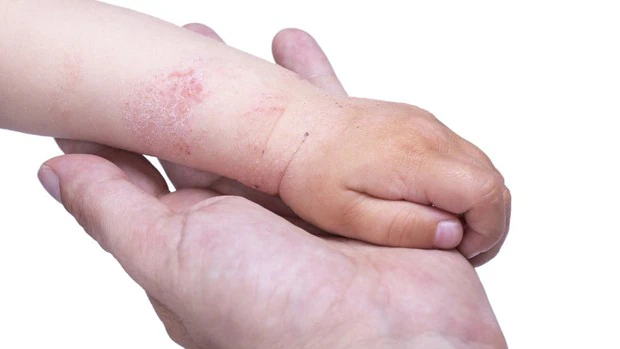 ¿Qué mascarillas y desinfectantes debo usar si mi hijo tiene dermatitis atópica?