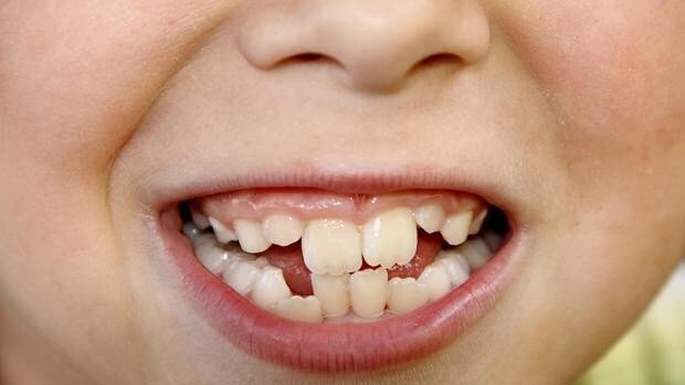Cuándo es el mejor momento para ponerle ortodoncia a tu hijo adolescente