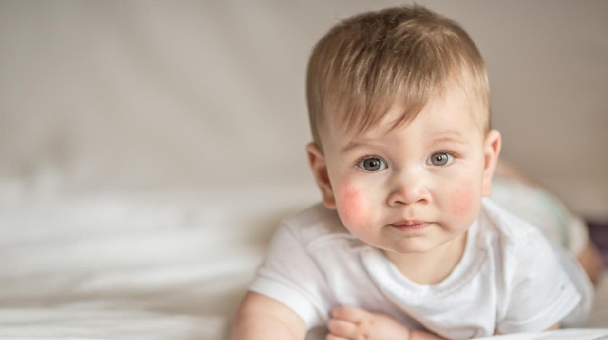 Cerca de un 20% de los niños son diagnosticados de dermatitis atópica