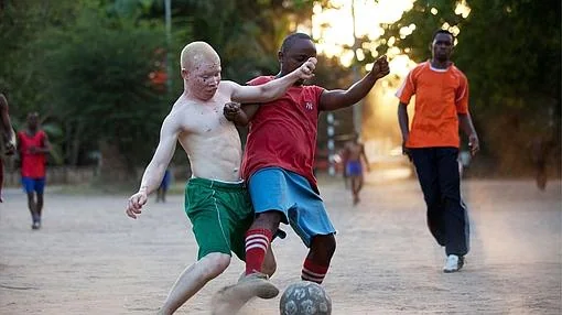 Los albinos tienen que luchar en África de forma diaria contra la marginación
