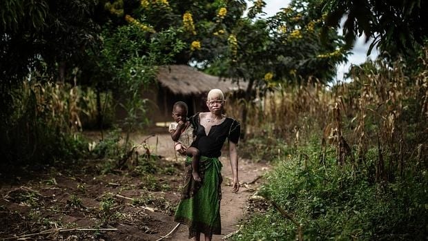 Albina africana, una raza que sufre continuos ataques