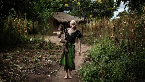 Una mujer con albinismo sostiene a su hijo en brazos en Malaui