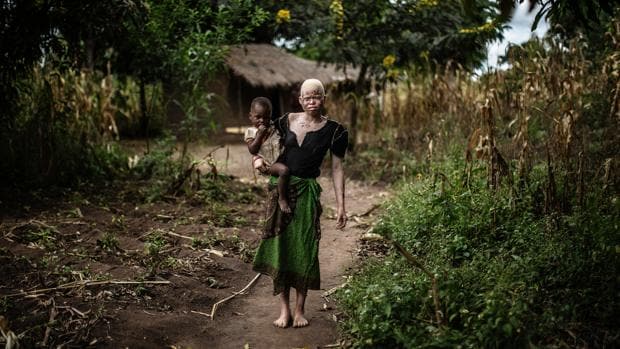 Una mujer albina posa con su hija en Malaui, donde las personas con albinismo son asesinadas y despedazadas