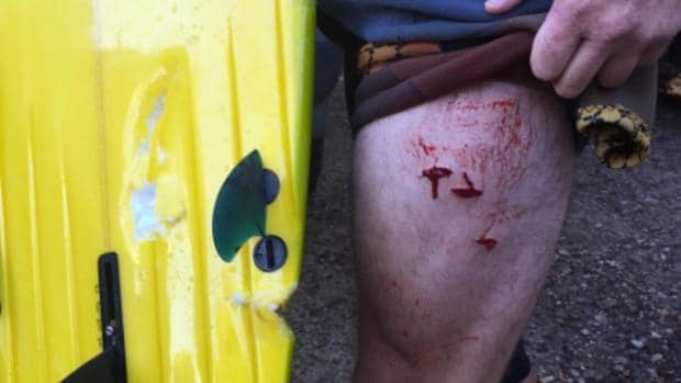El surfista muestra las heridas del ataque del tiburón