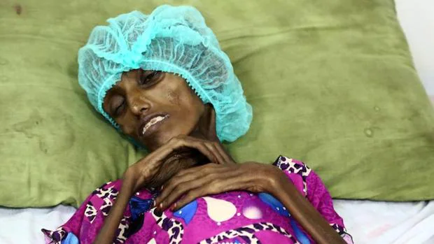 Saida Ahmad Baghili, la joven yemení de 18 años ingresada por desnutrición