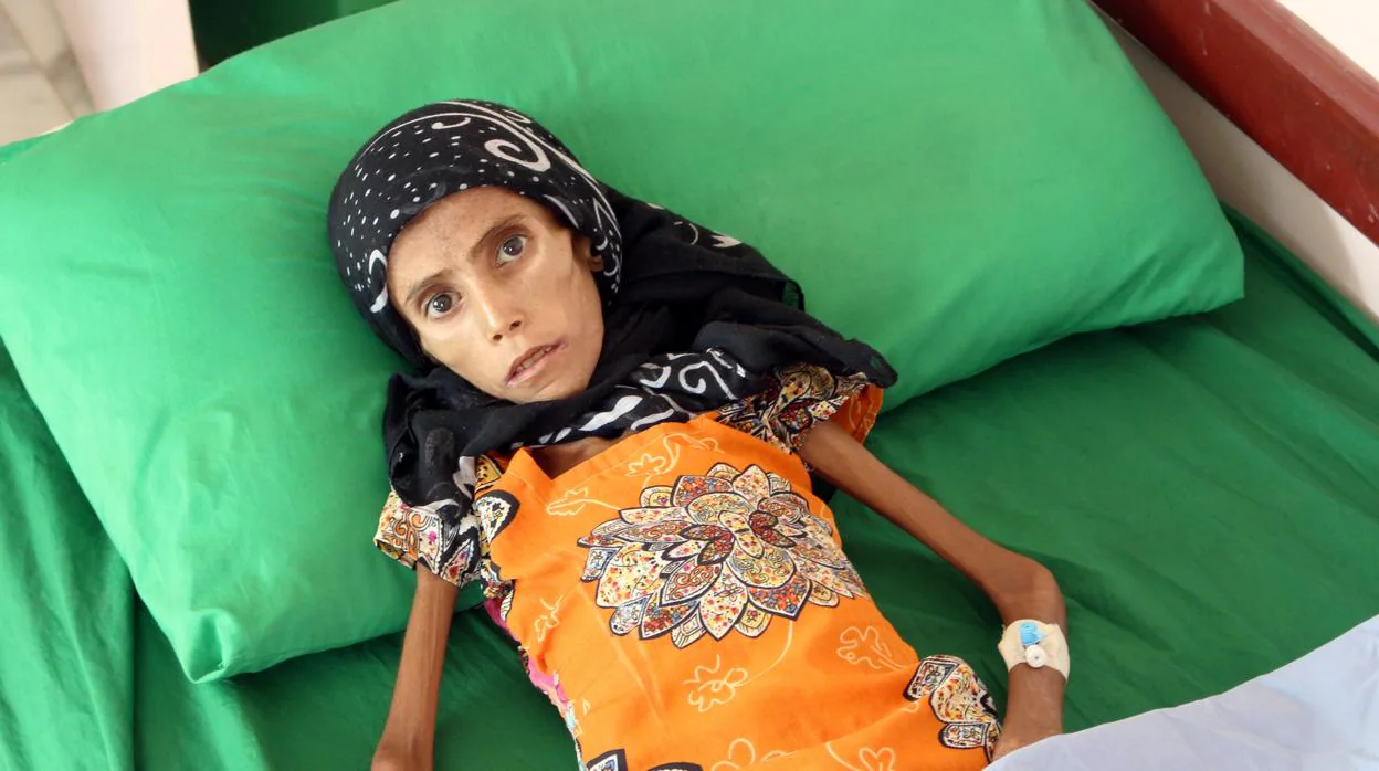 Fatima Qoba yace en una cama en una clínica de Aslam, en la provincia de Hajjah, en Yemen