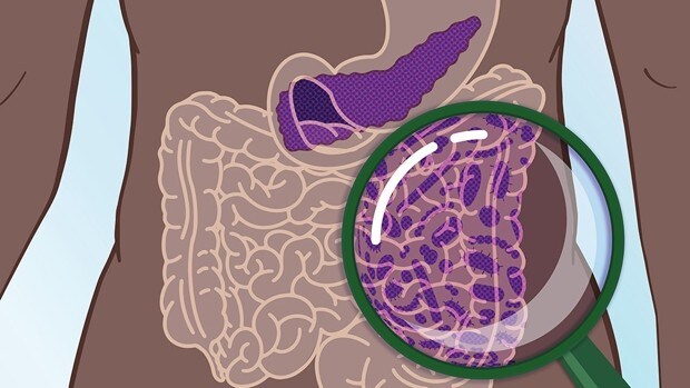 Primera prueba para detectar precozmente el cáncer de páncreas cuando aún es curable