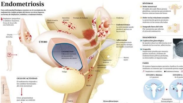 Infografía sobre la endometriosis