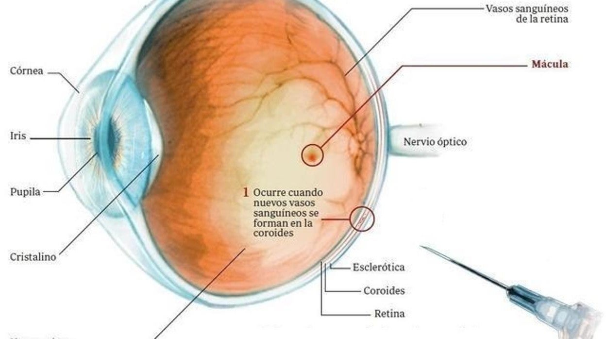 El Hospital Punta de Europa implanta una nueva terapia para tratar enfermedades de la retina