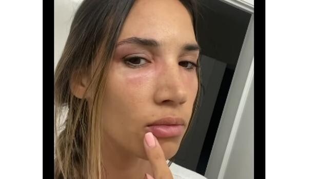 Susto de India Martínez que aparece con la cara desfigurada por una alergia
