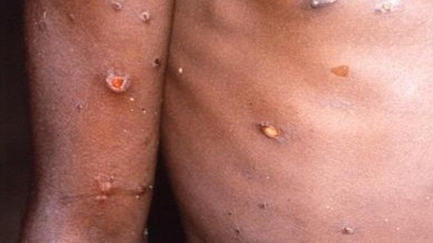 La Junta detecta un caso sospechoso de ser viruela del mono en la provincia de Cádiz