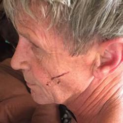 El oso también le hirió en la cara