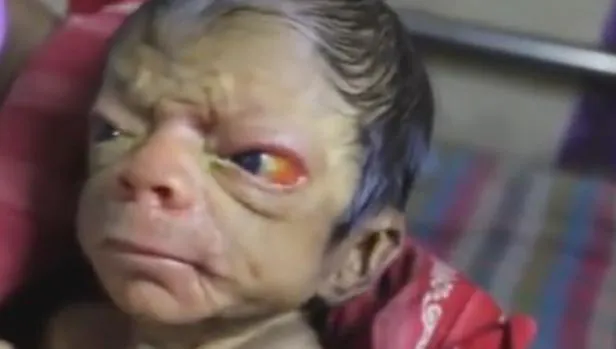 Youtube: El extraño caso del bebé de Bangladés con cara de anciano y pelos en la espalda