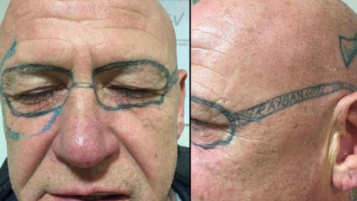 Un hombre tarda dos años en quitarse el tatuaje de unas gafas que se hizo cuando estaba de fiesta