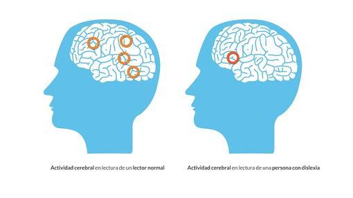 Actividad cerebral de una persona con o sin dislexia