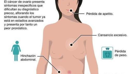 Síntomas del cáncer de ovario