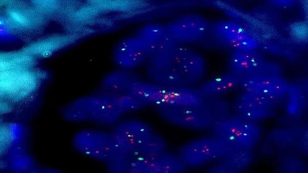 Amplificación por fluorescencia del gen HER2 en células de cáncer de mama