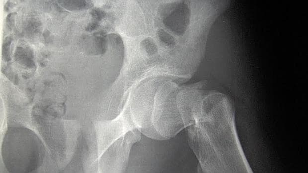 Fractura de cadera por osteoporosis