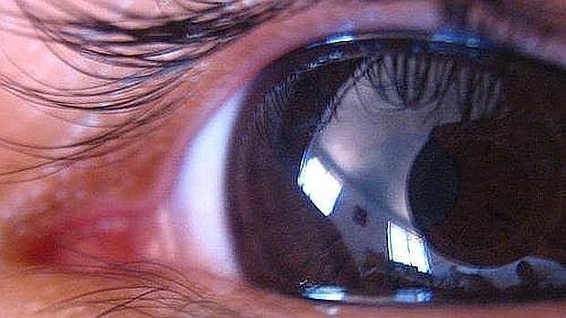 En nuestro país convivien cerca de un millón de personas con glaucoma
