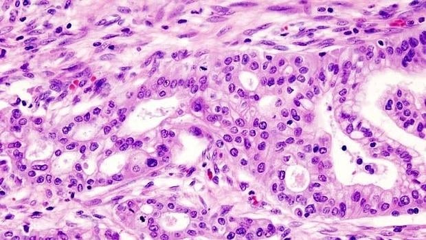 Adenocarcinoma ductal de páncreas