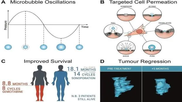 Aumento de la supervivencia en el cáncer de páncreas con la 'sonicación celular'