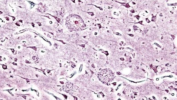 Placas de beta-amiloide en el cerebro de un paciente con alzhéimer