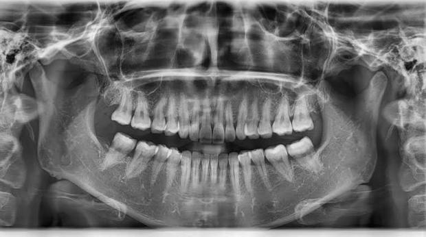 Las infecciones dentales que requieren endodoncia también aumentan el riesgo cardiovascular