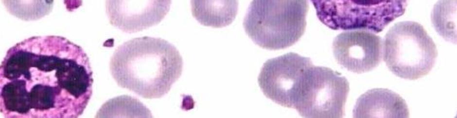 Leucemia mieloide aguda