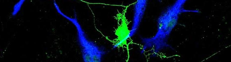 Células del glioma (azul) crecienciendo en torno a las neuronas (verde)