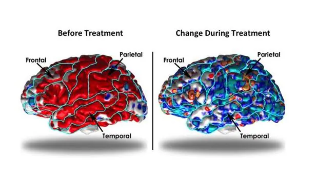 Cambios en el grosor de la corteza durante el tratamiento con antidepresivos (izquierda)