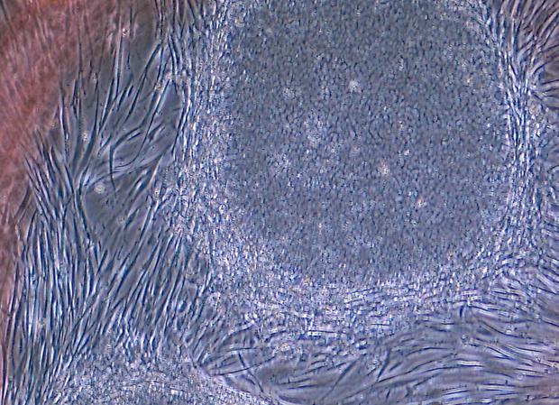 El primer trasplante de retina fabricado con piel detiene la progresión de una degeneración macular