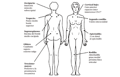 Puntos dolorosos en fibromialgia