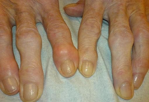 Paciente con artrosis en los dedos