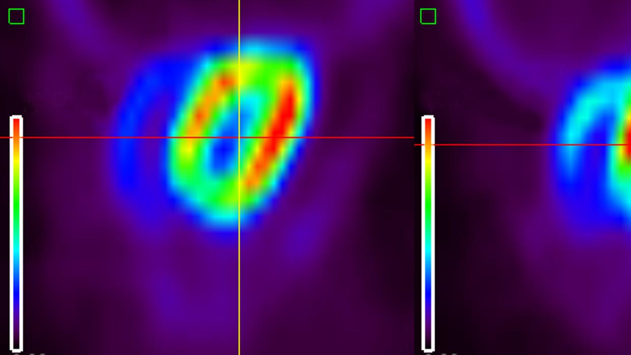 Imágenes de tomografía por emisión de positrones (PET) mostrando actividad cardiaca incrementada (rojo) en ratones con niveles deficientes en Plk1 (derecha) en comparación con ratones normales (izquierda