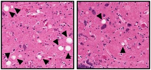 Diseñado un fármaco capaz de evitar la muerte de las neuronas cerebrales en el alzhéimer