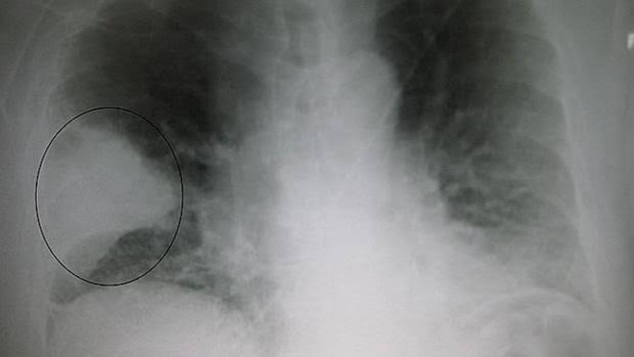 La fibrosis quística causa una acumento de la mucosidad en los pulmones