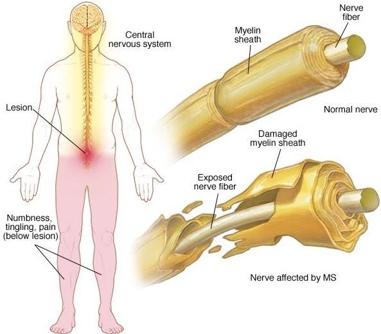 Las técnicas de imagen permiten saber si la terapia remielinizante es eficaz en esclerosis múltiple