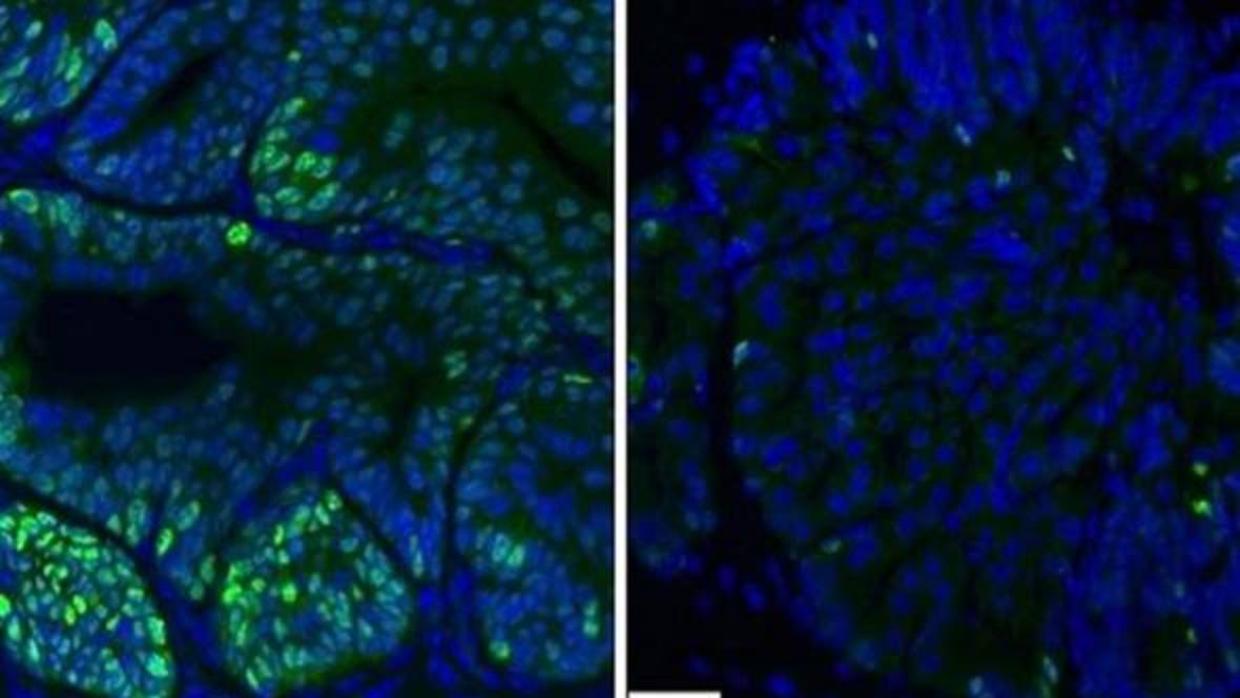 Eliminacion de células de cáncer de próstata (en verde) con el tratamiento con deguelina (derecha)