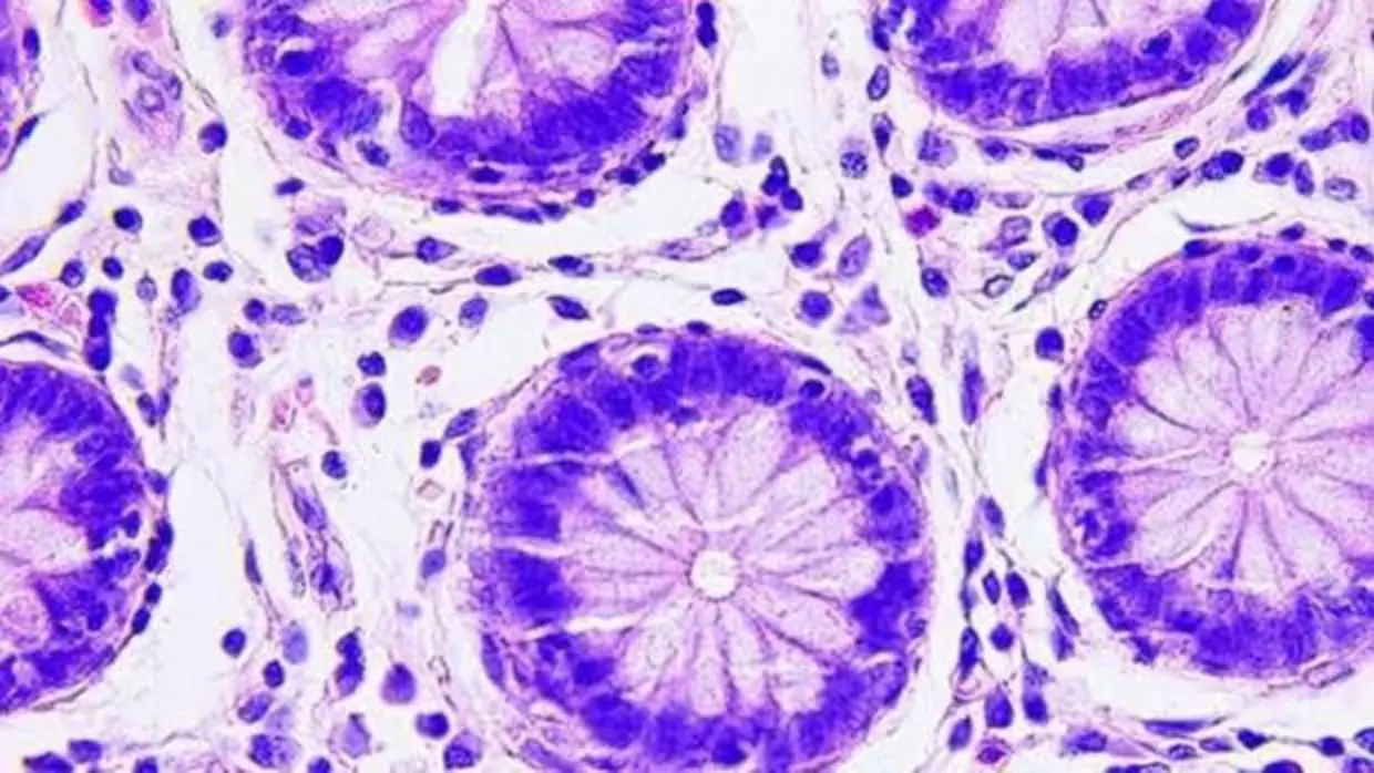 Células de cáncer colorrectal
