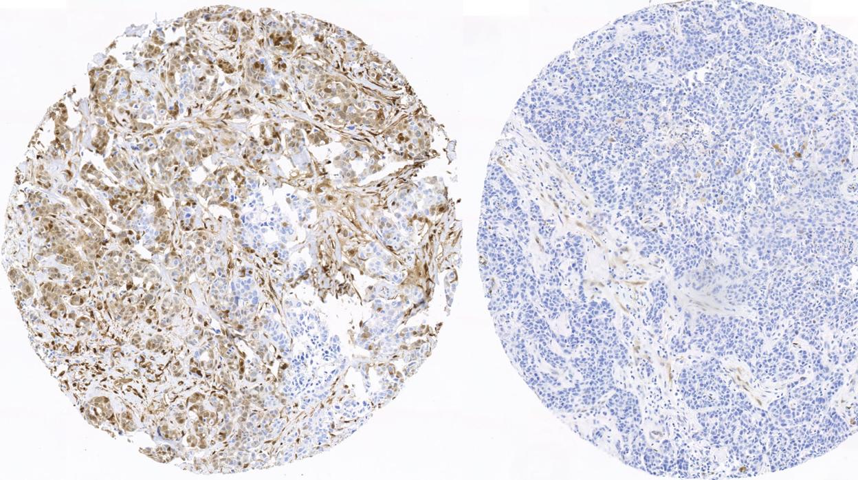 Tejido mamario de una paciente con recaída y que presenta los marcadores de fosforilación activos (izquierda; color marrón intenso), frente al tejido procedente de una paciente sin recaída y que no presenta estos marcadores activos (derecha)