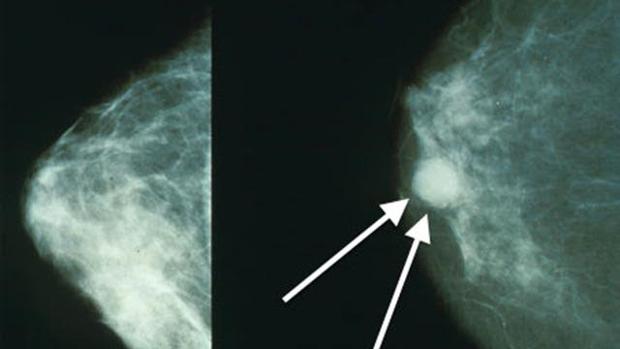 Dieta mediterránea para prevenir el cáncer de mama