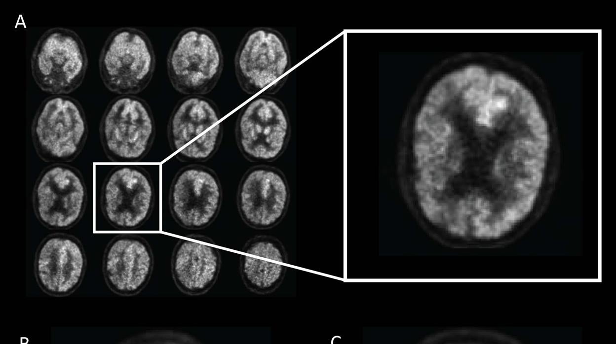 Cerebro con alzhéimer