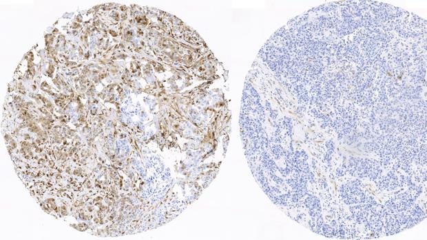 El cáncer escondido: el tumor de cabeza y cuello