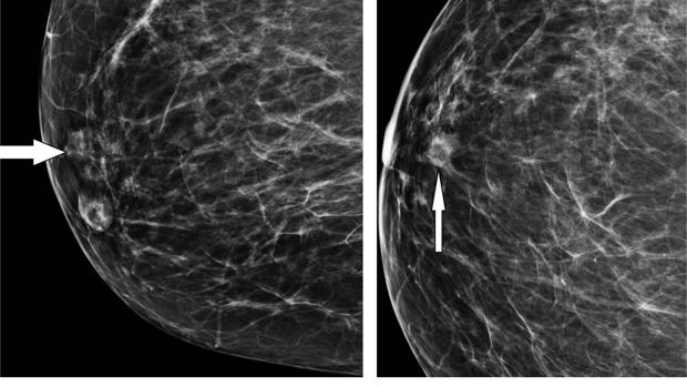 Una nueva técnica puede reducir significativamente las biopsias de mama