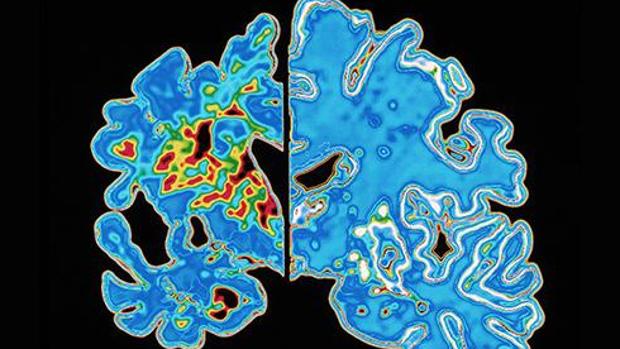 El uso a largo plazo de la THS se relaciona con un mayor riesgo de Alzheimer