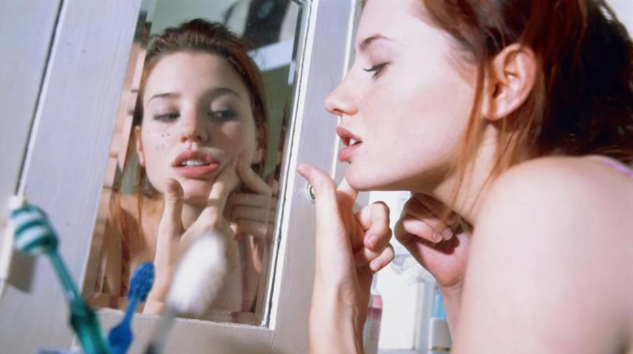 El acné deja marcas que pueden eliminarse con láser